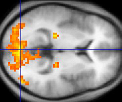 fMRI of Tonal Area in Brain